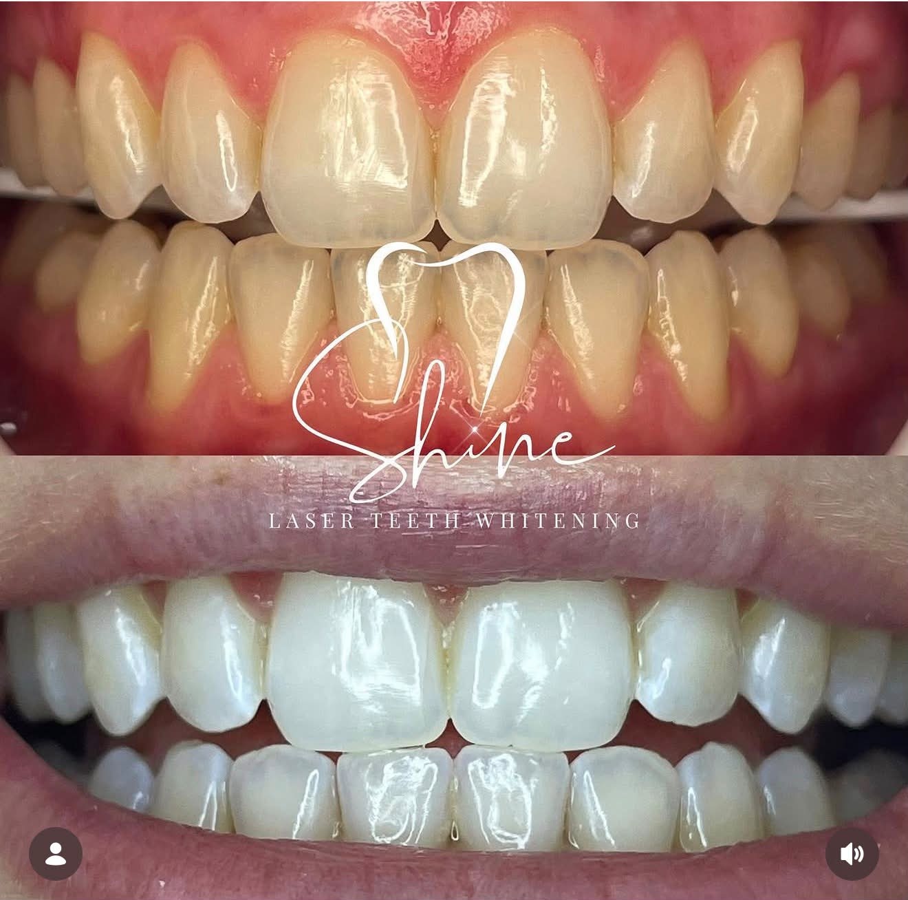 Shine laser teeth whitening treatment